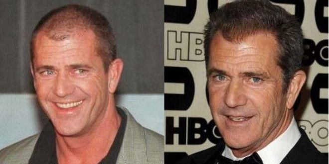 Fotos de celebridades antes y después del implante de cabello