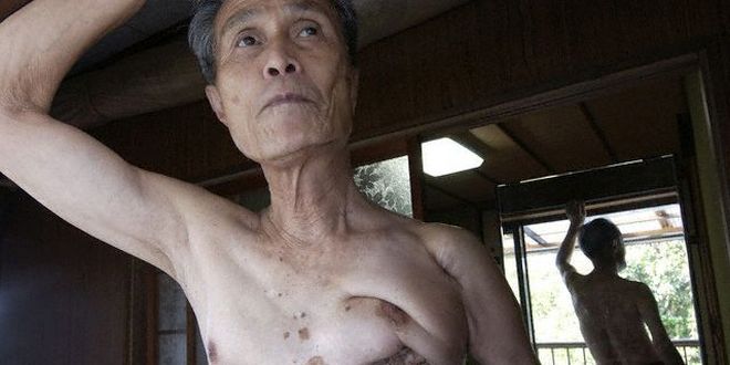 Sobreviviente de la bomba atómica de Nagasaki revive la tragedia mostrando las cicatrices que le dejó la explosión