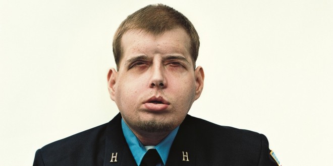 Dramático cambio del bombero que recibió el trasplante de cara más extenso en la historia